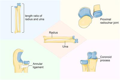 What do we need to address when we treat neglected Monteggia fracture in children